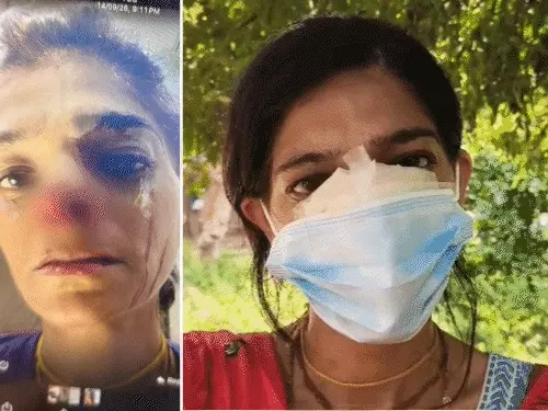 मथुरा में गोवर्धन परिक्रमा के बीच श्रद्धालु युवती पर हमला, नाक से आभूषण लेकर भागा युवक; CCTV खंगाल रही पुलिस